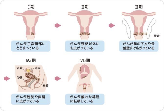 Ⅰ期.がんが子宮頸部にとどまっている Ⅱ期.がんが頸部以外にも広がっている Ⅲ期.がんが腟の下方や骨盤壁まで広がっている Ⅳa期.がんが膀胱や直腸に広がっている Ⅳb期.がんが離れた場所に転移している